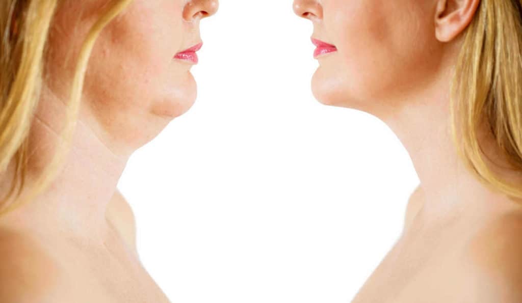 Double Chin treatment Great Barr before and after results