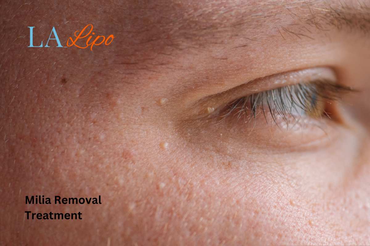 Cryopen Milia Removal: Is It the Easiest and Safest Option Great Barr?