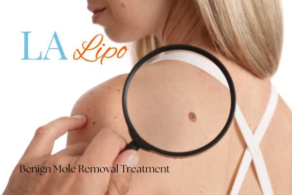 Woman having her inspection of blemish before mole removal Great Barr