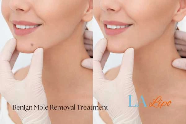 woman's before and after mole removal Great Barr results