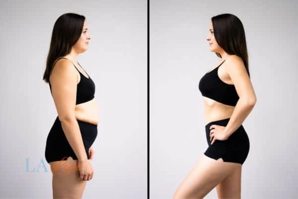 image of woman before and after results of LA-EMS Body Sculpting Great Barr to help treat Diastasis recti