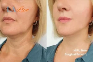 hi-fu for wrinkles Great Barr before and after results