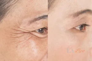 Before and after results of woman - HI-fu wrinkles reduction treatment Great Barr