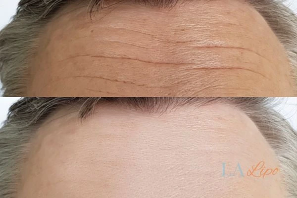 results of HIFU Great Barr on mans forehead to help reduce lines and wrinkles