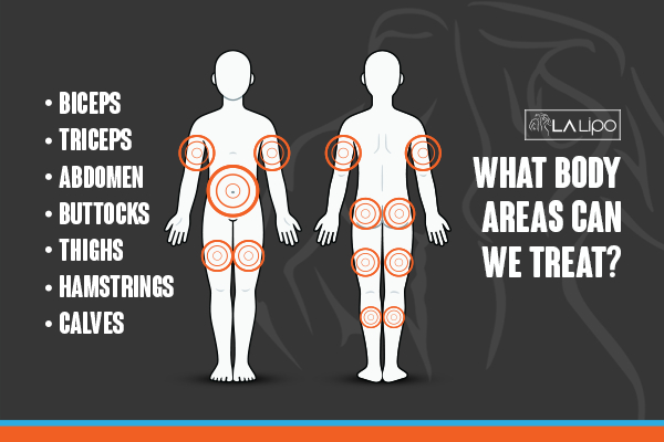 Graphic to show areas you can have LA-EMS Body Sculpting Great Barr treatment.