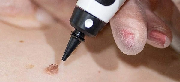 skin tag removal using cryopen Great Barr