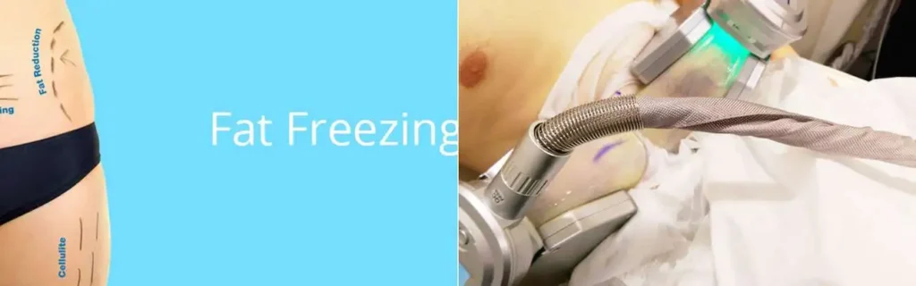 Fat freezing Great Barr on multiple areas of the body