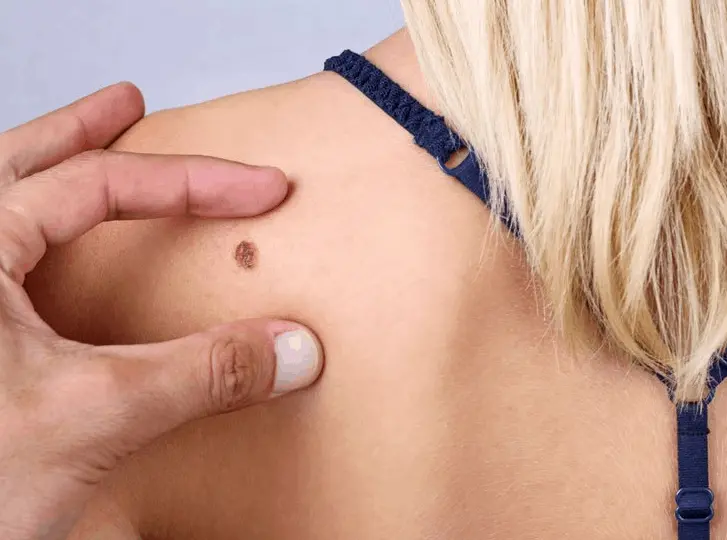 woman having mole removal Great Barr consultation before treatment.