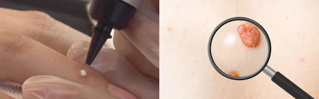 CryoPen practitioner Great Barr assessing a benign mole before treatment