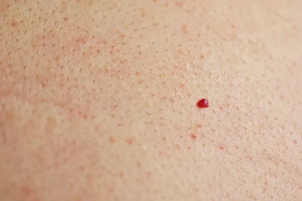 close up of a cherry angioma Great Barr