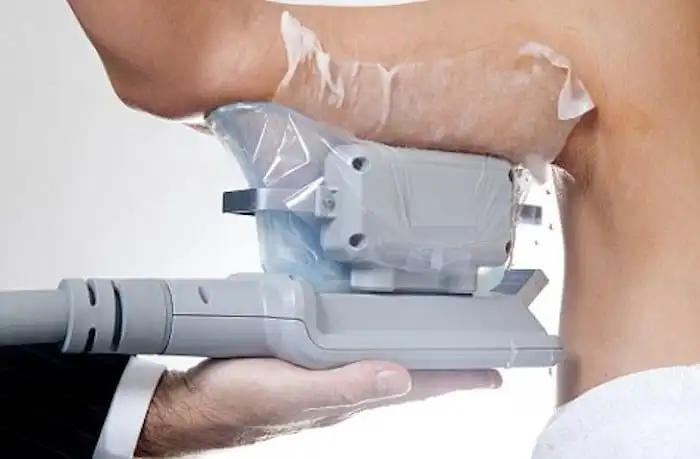 Picture of fat freezing Great Barr on the upper arms.