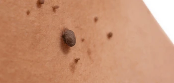 image of a skin tag Great Barr