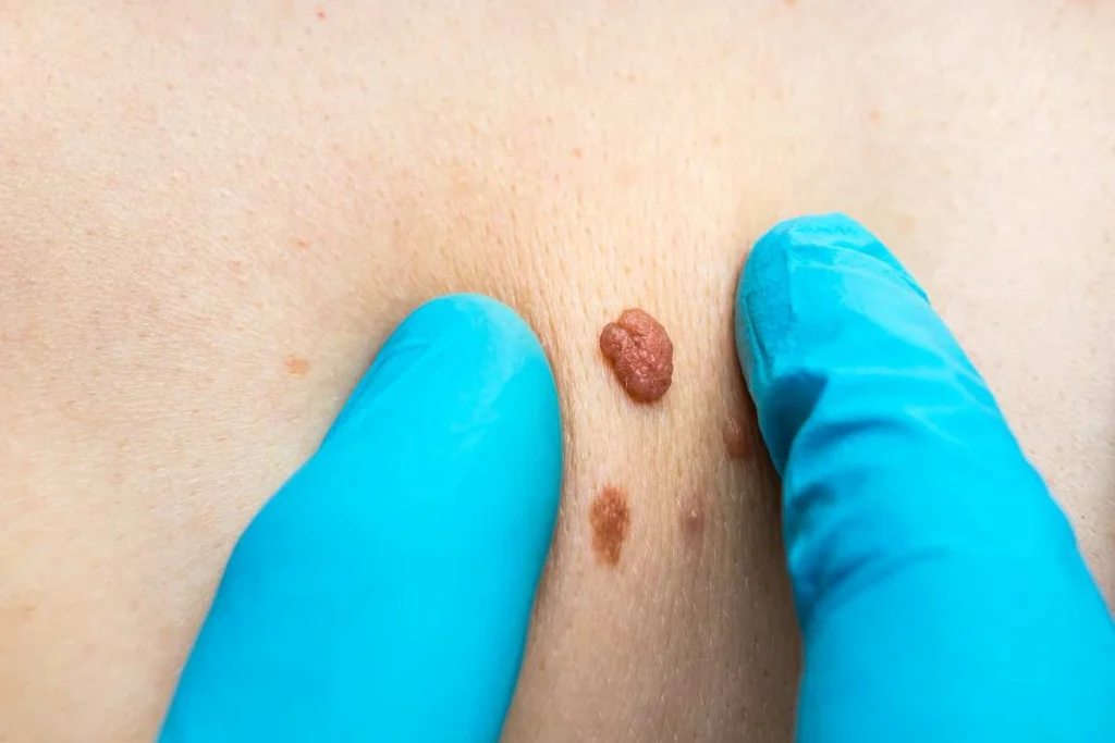 Consultant examining a skin tag Great Barr