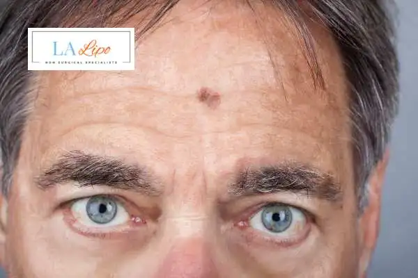 Solar Lentigo Removal Great Barr image of man with mark on his forehead