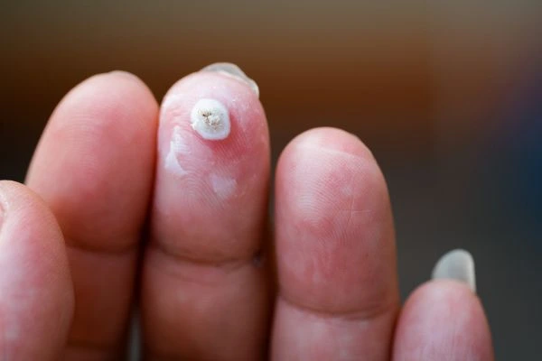 wart on person finger - cryotherapy to treat from LA LIPO Great Barr