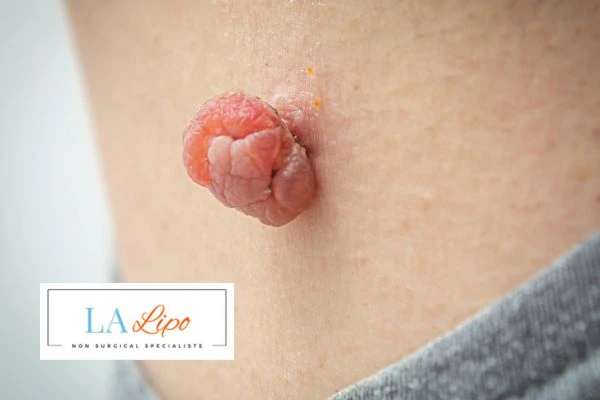 Interested in skin tag removal Great Barr? Concerned about the pain? Find out more today!