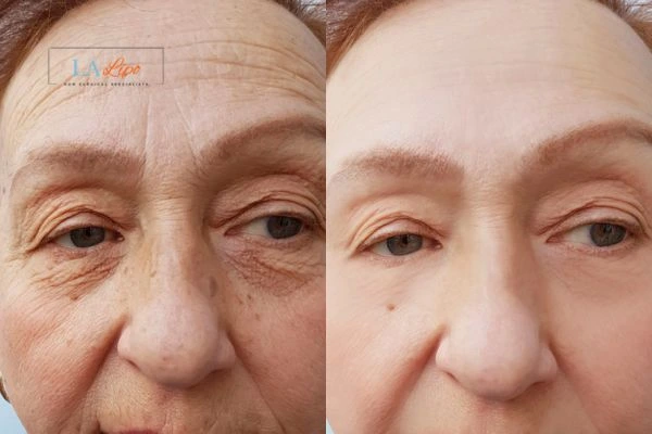 The powerful benefits of Morpheus8 Treatment Great Barr - Call Our team today!