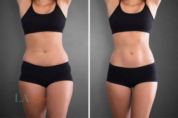before and after results of non-surgical treatment to help a woman's body image and mental health Great Barr