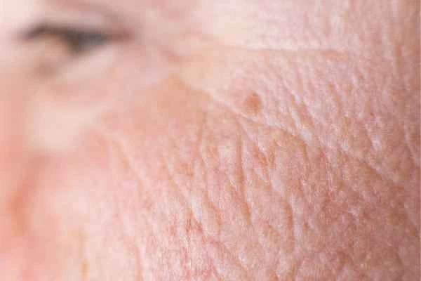 close up picture of a woman's face showing an age spot Great Barr