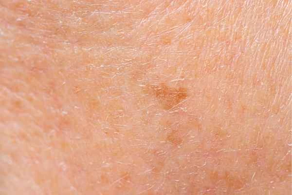 close up picture of age spots Great Barr