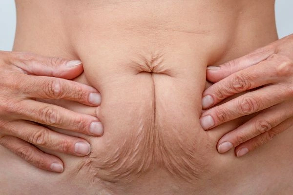 Should I Combine Diastasis Recti Treatment with Body Contouring for Better Results Great Barr?