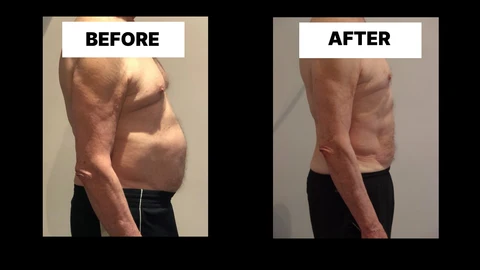 What Symptoms Can Diastasis Recti Cause in Men? Weak Core, Back Pain and Poor Posture Great Barr
